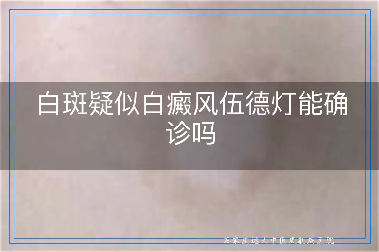 白斑疑似白癜风伍德灯能确诊吗