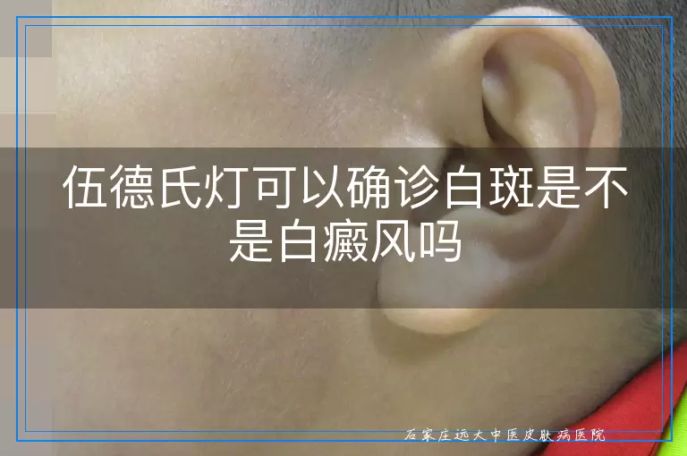 伍德氏灯可以确诊白斑是不是白癜风吗