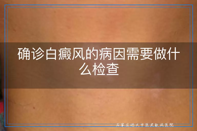 确诊白癜风的病因需要做什么检查