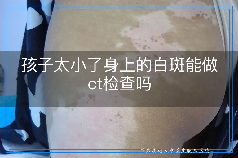 孩子太小了身上的白斑能做ct检查吗