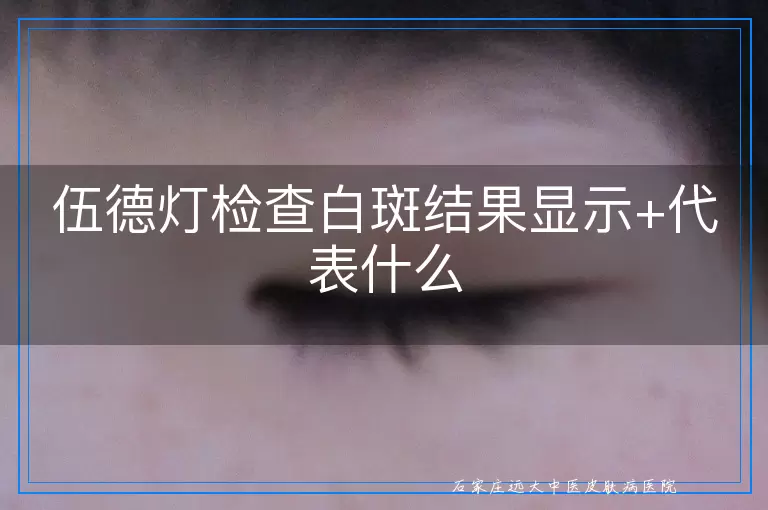 伍德灯检查白斑结果显示+代表什么