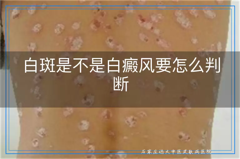 白斑是不是白癜风要怎么判断
