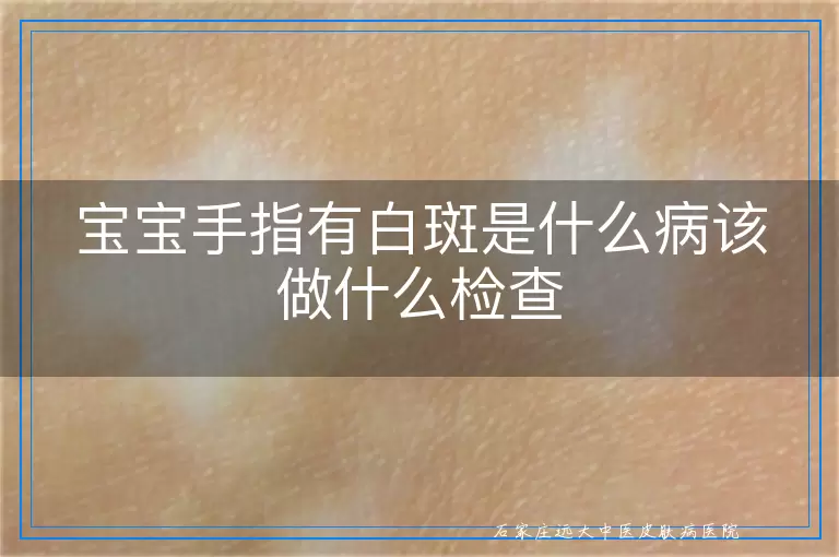 宝宝手指有白斑是什么病该做什么检查