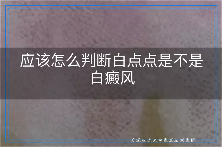 应该怎么判断白点点是不是白癜风