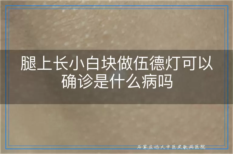 腿上长小白块做伍德灯可以确诊是什么病吗