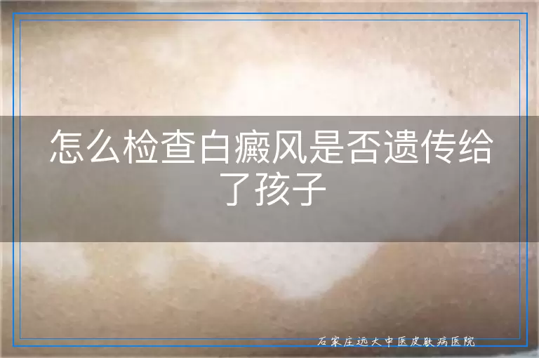 怎么检查白癜风是否遗传给了孩子