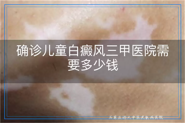 确诊儿童白癜风三甲医院需要多少钱