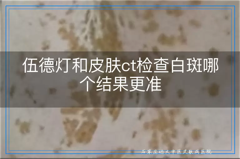 伍德灯和皮肤ct检查白斑哪个结果更准