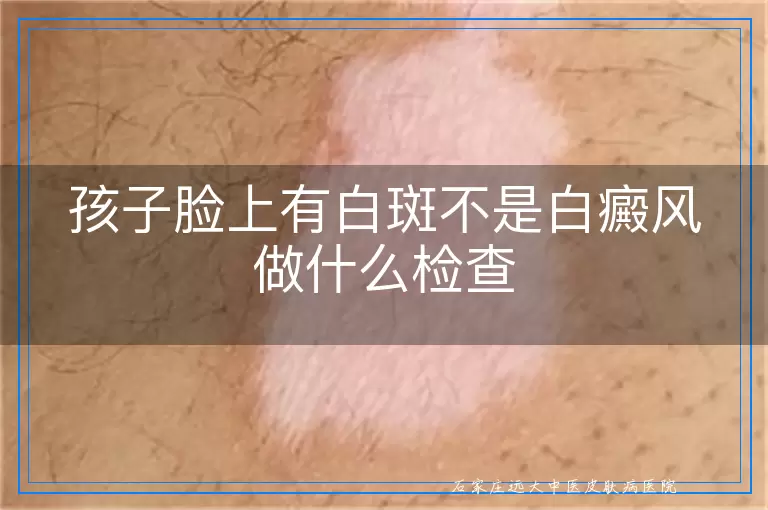 孩子脸上有白斑不是白癜风做什么检查