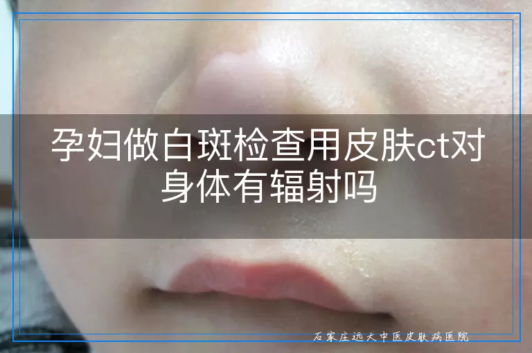 孕妇做白斑检查用皮肤ct对身体有辐射吗