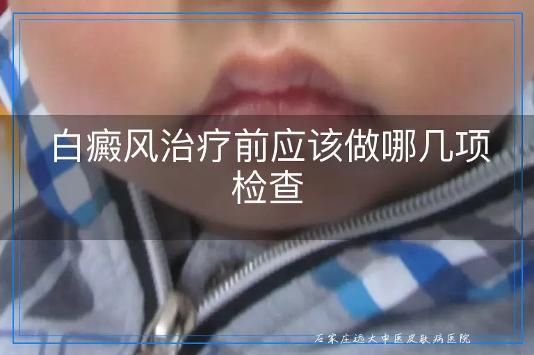 白癜风治疗前应该做哪几项检查