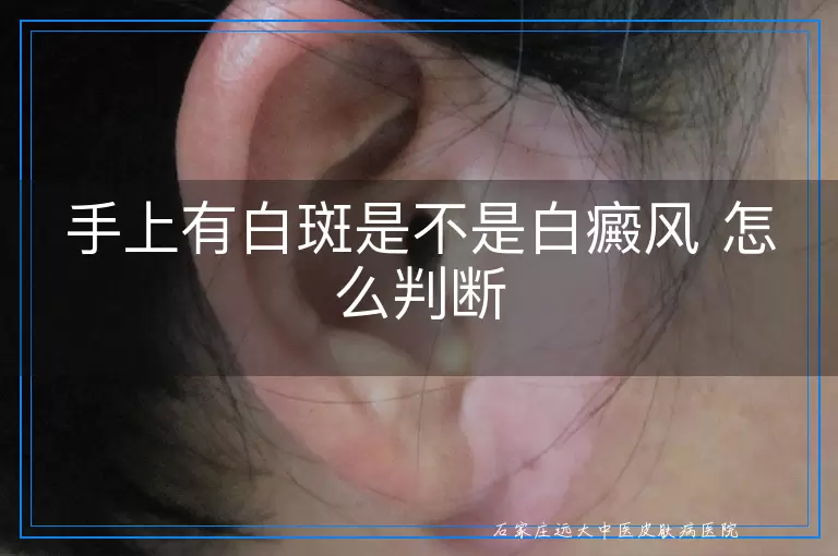 手上有白斑是不是白癜风 怎么判断