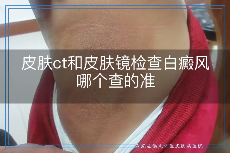 皮肤ct和皮肤镜检查白癜风哪个查的准