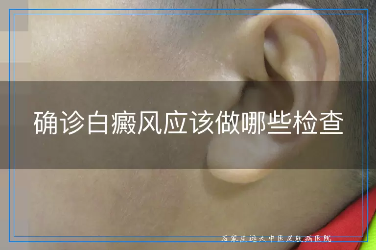确诊白癜风应该做哪些检查