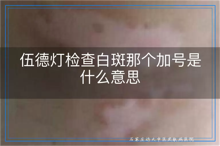 伍德灯检查白斑那个加号是什么意思