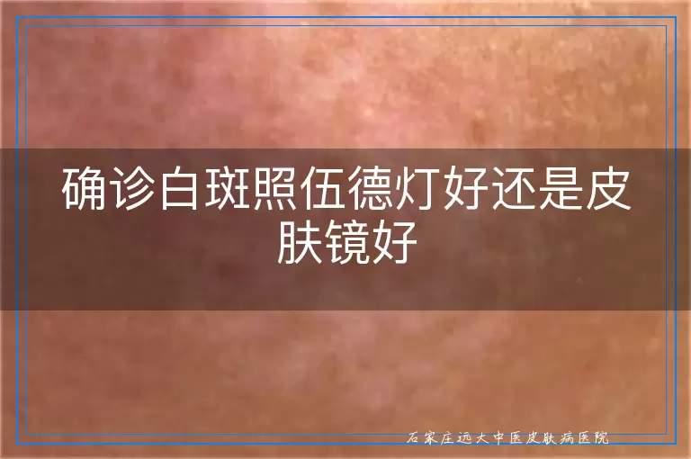 确诊白斑照伍德灯好还是皮肤镜好
