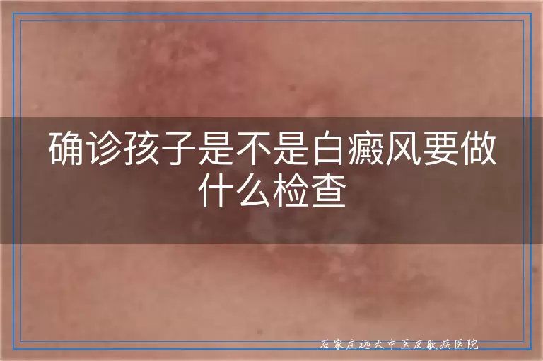 确诊孩子是不是白癜风要做什么检查