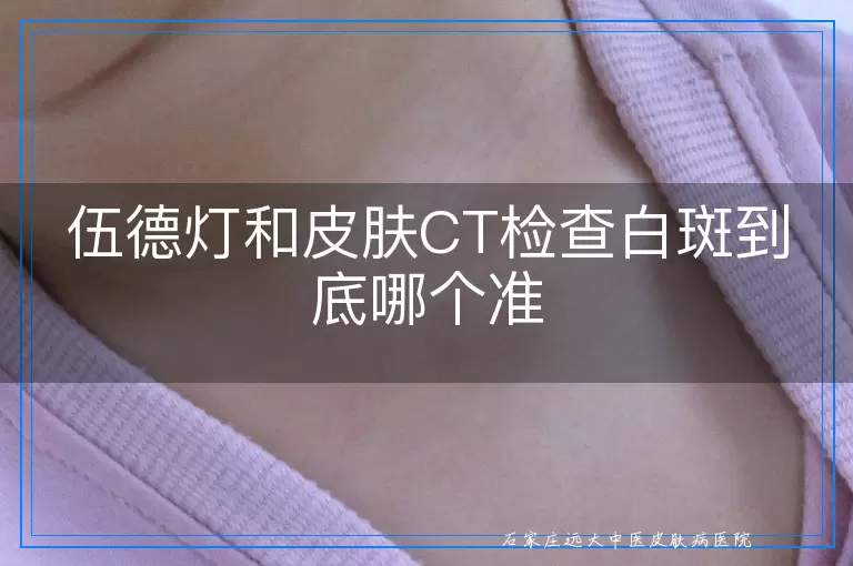 伍德灯和皮肤CT检查白斑到底哪个准