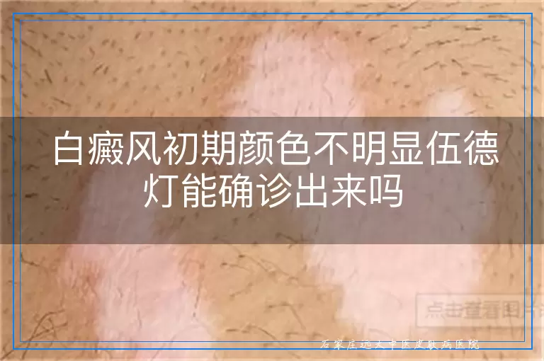 白癜风初期颜色不明显伍德灯能确诊出来吗