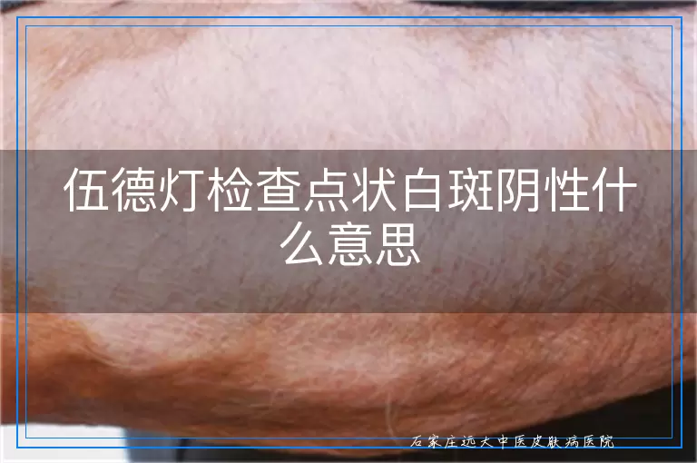 伍德灯检查点状白斑阴性什么意思