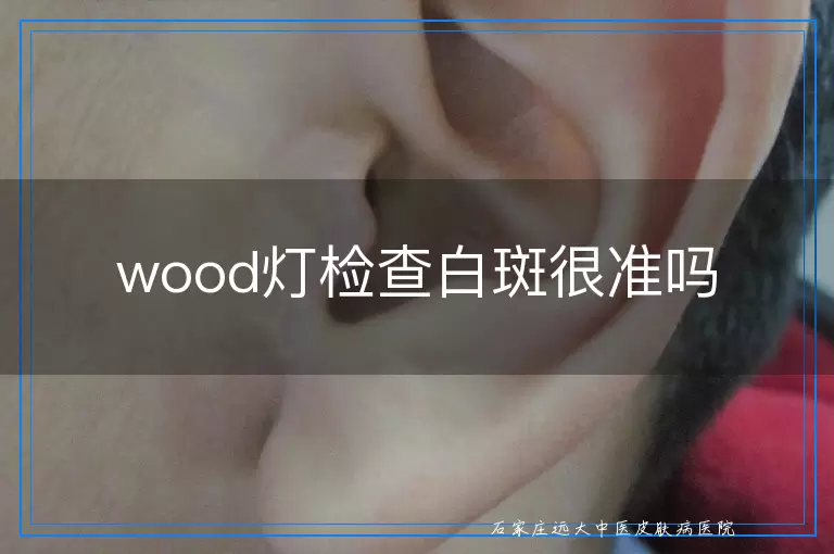 wood灯检查白斑很准吗