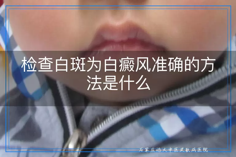 检查白斑为白癜风准确的方法是什么