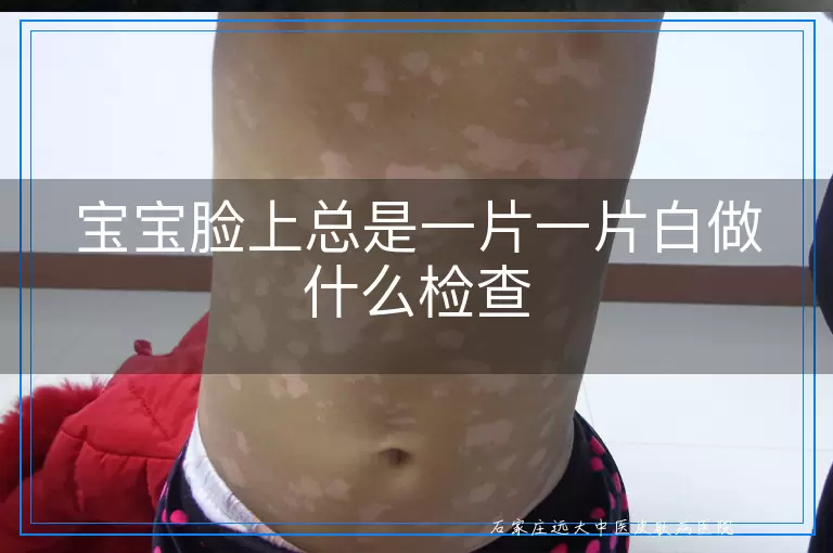 宝宝脸上总是一片一片白做什么检查