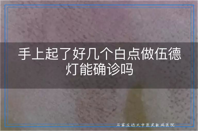 手上起了好几个白点做伍德灯能确诊吗