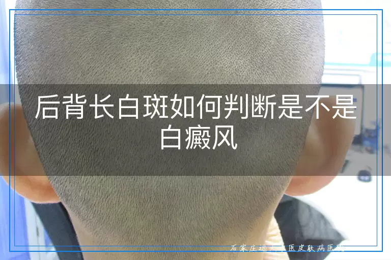 后背长白斑如何判断是不是白癜风