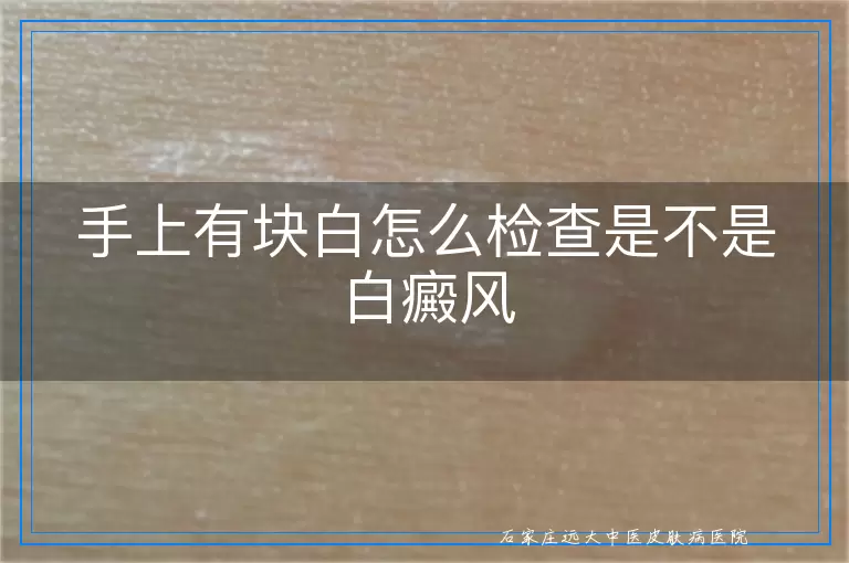 手上有块白怎么检查是不是白癜风
