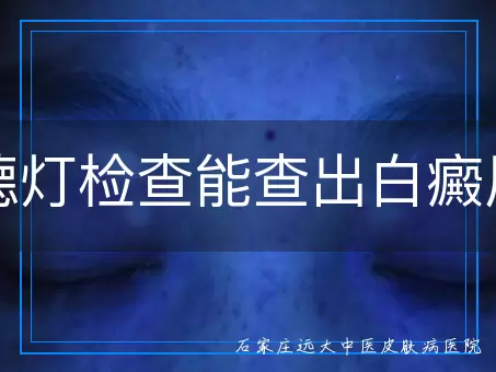 伍德灯检查能查出白癜风吗