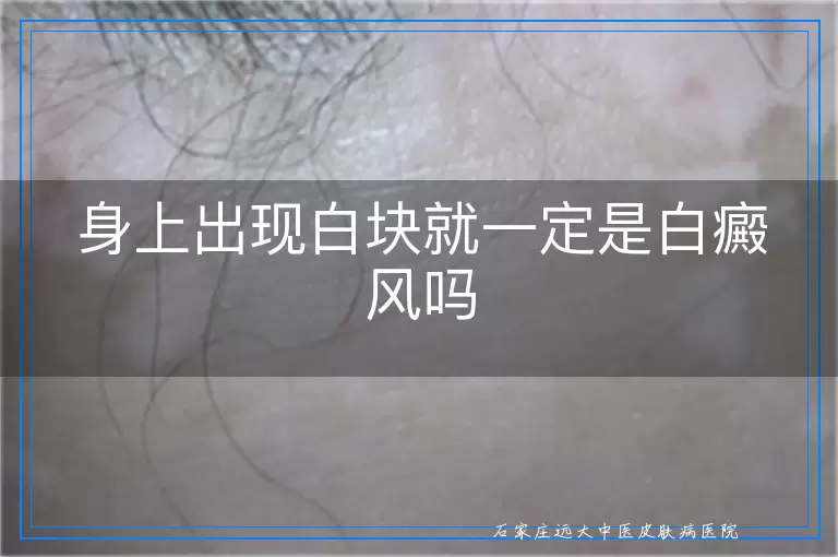 身上出现白块就一定是白癜风吗