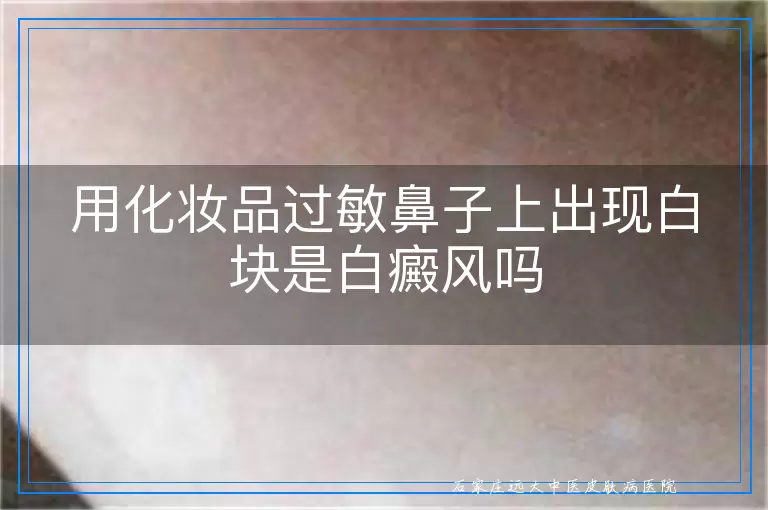 用化妆品过敏鼻子上出现白块是白癜风吗
