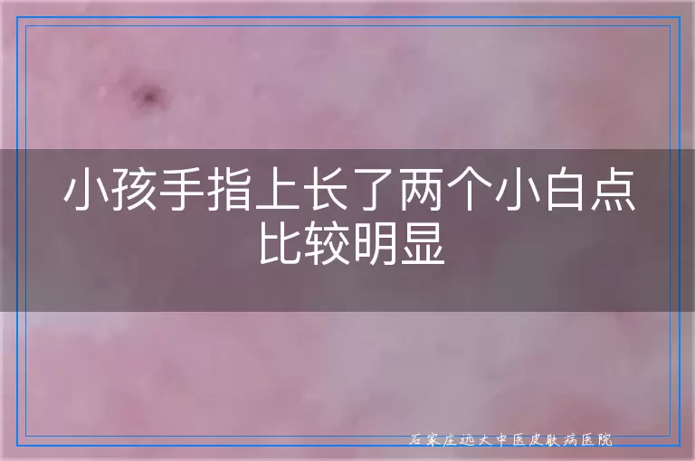 小孩手指上长了两个小白点比较明显