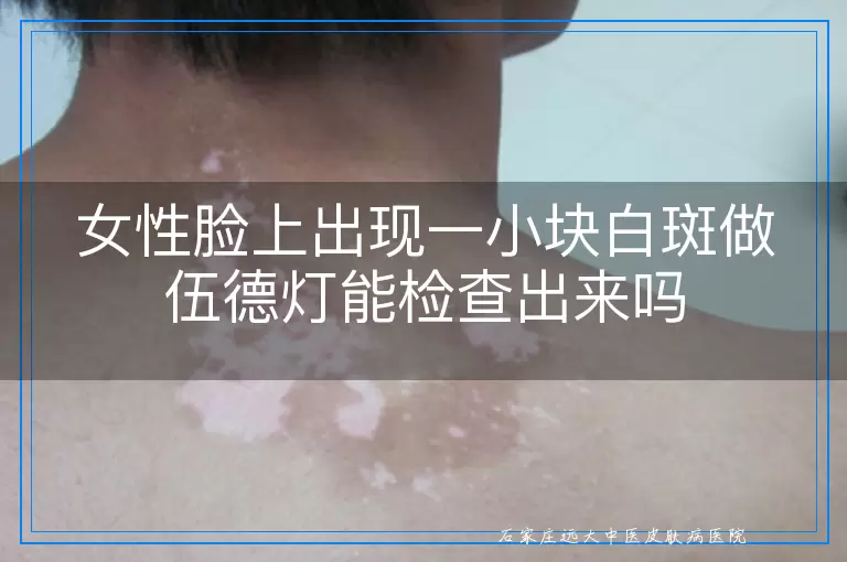 女性脸上出现一小块白斑做伍德灯能检查出来吗