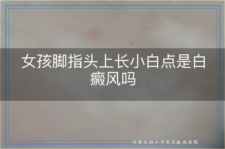 女孩脚指头上长小白点是白癜风吗