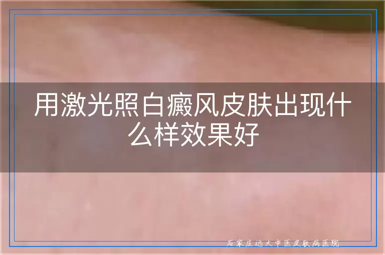 用激光照白癜风皮肤出现什么样效果好