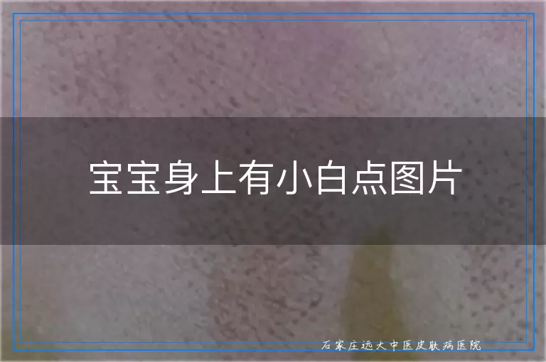 宝宝身上有小白点图片