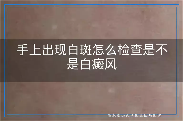 手上出现白斑怎么检查是不是白癜风
