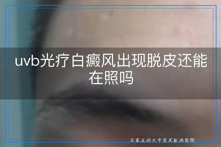 uvb光疗白癜风出现脱皮还能在照吗