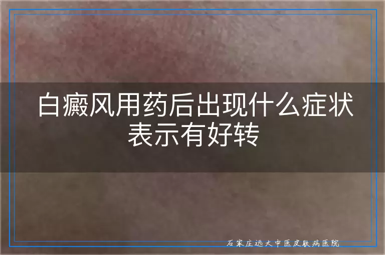 白癜风用药后出现什么症状表示有好转