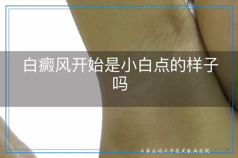 白癜风开始是小白点的样子吗