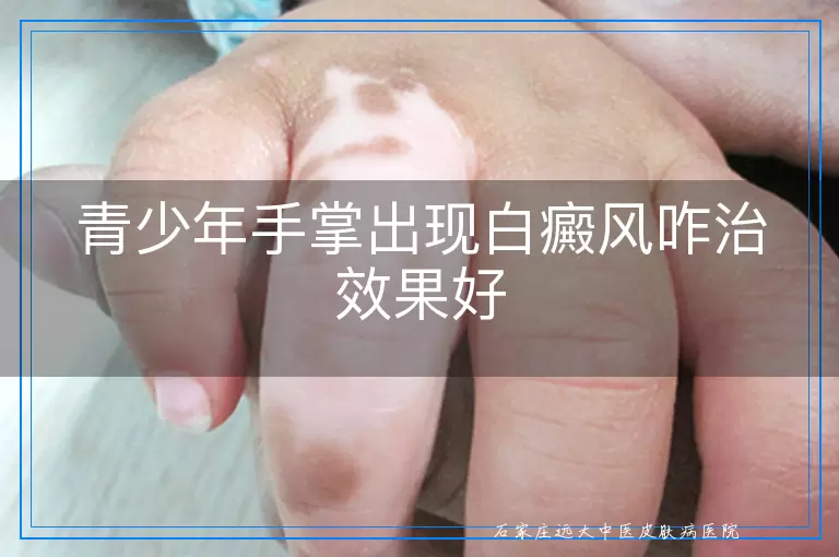青少年手掌出现白癜风咋治效果好