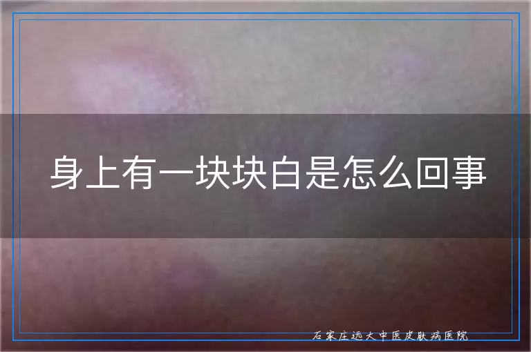 身上有一块块白是怎么回事