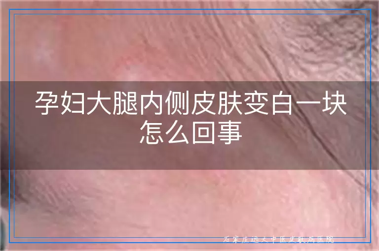 孕妇大腿内侧皮肤变白一块怎么回事