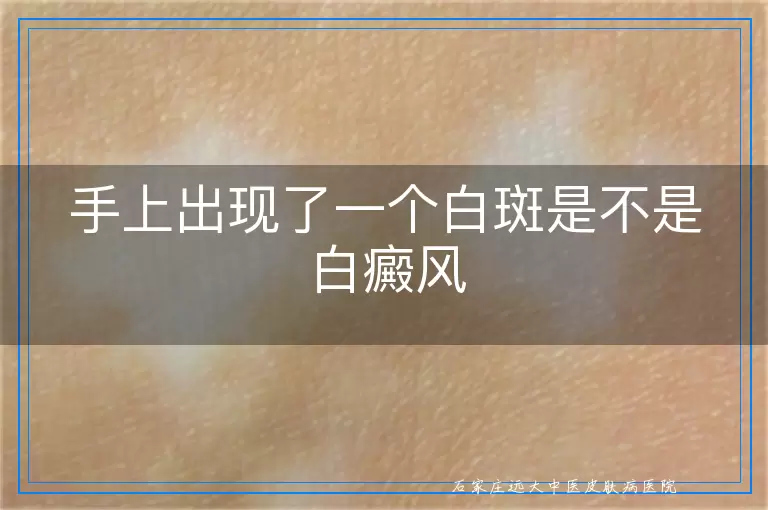手上出现了一个白斑是不是白癜风