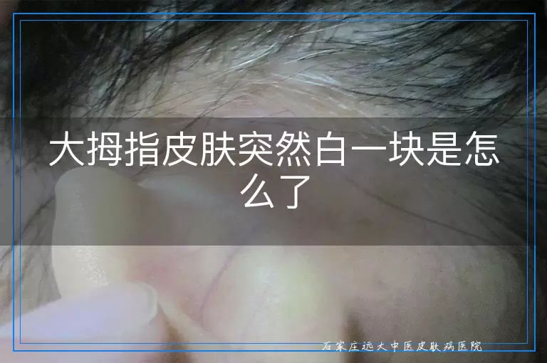 大拇指皮肤突然白一块是怎么了