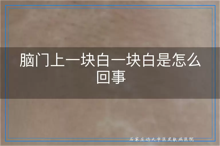 脑门上一块白一块白是怎么回事