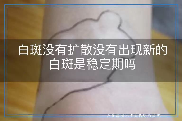白斑没有扩散没有出现新的白斑是稳定期吗