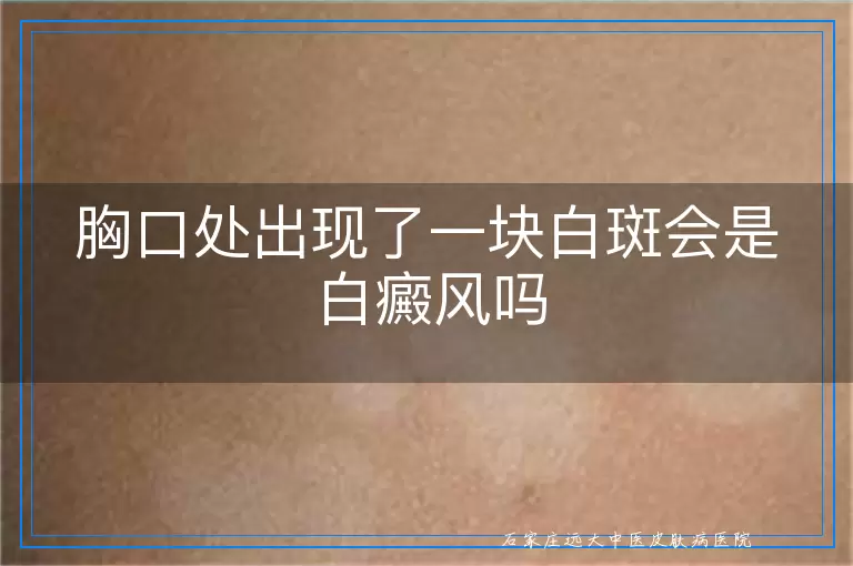 胸口处出现了一块白斑会是白癜风吗